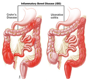 Complication of IBD is crohns or ulcerative colitis