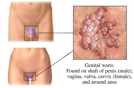 common warts on legs. WARTS-overview