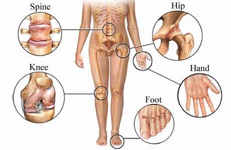 arthritis knee joint. Osteoarthritis- Overview