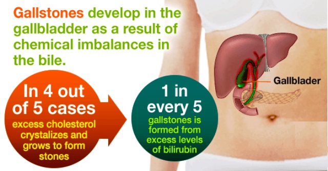 Research paper cholecystectomy