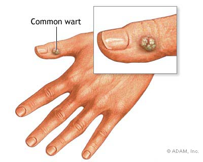 common warts on fingers. Who Gets Warts ?
