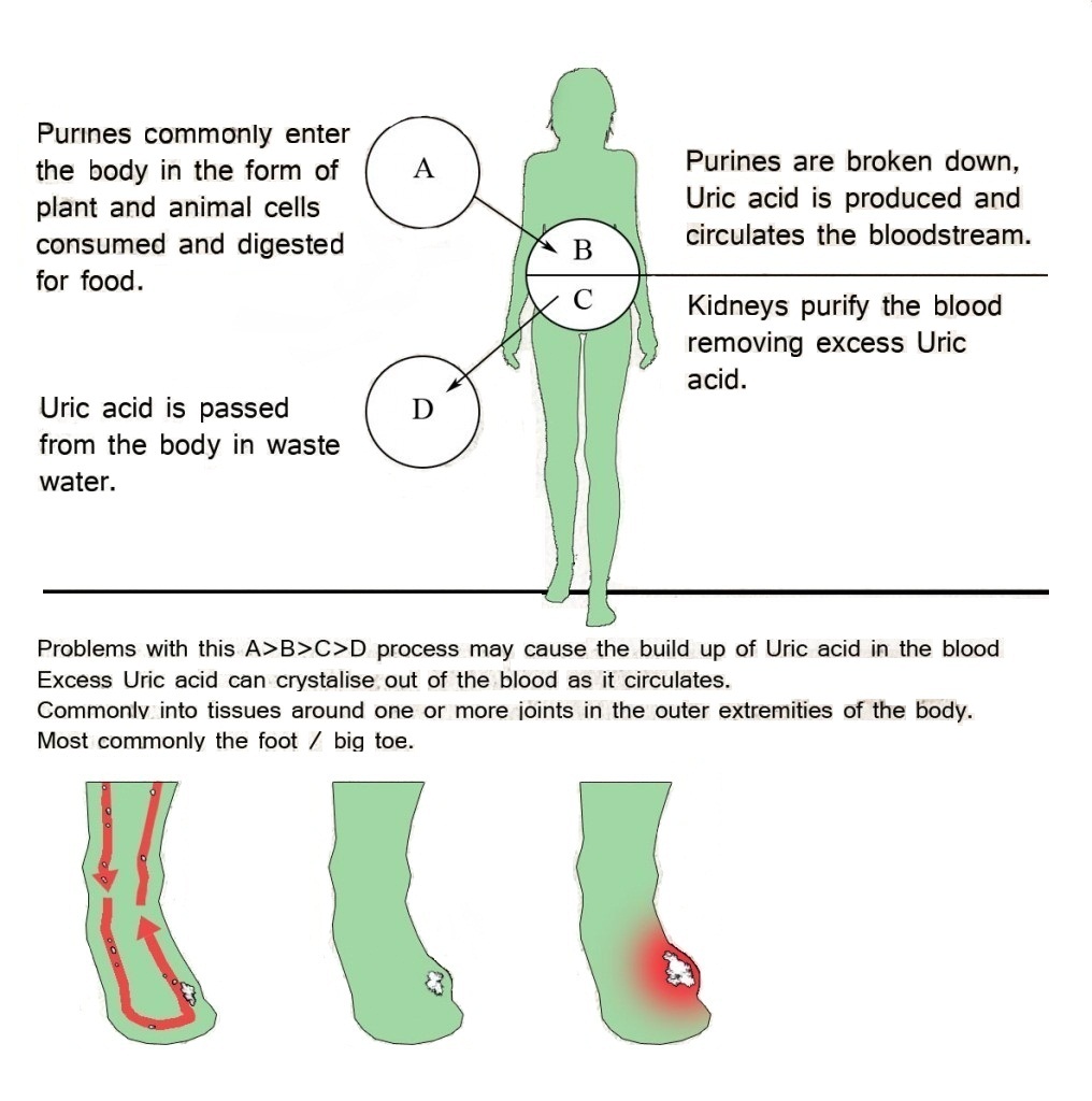 gout in ankle treatment