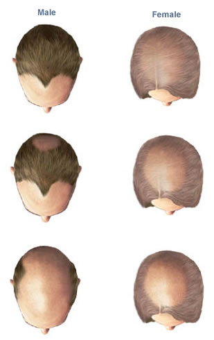 alopeciaareata homoeopathic treatment
