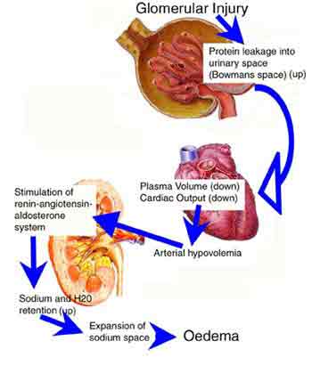 kidney failure heart failure oedema Na K imbalance in serum