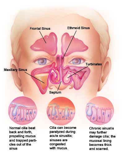 Corticosteroid drug