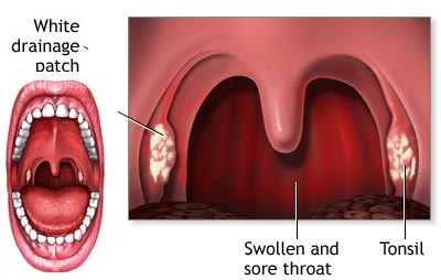 sneezing swollen tonsils