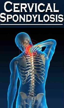 Cervical spondylosis neck pain Homeopathic treatment