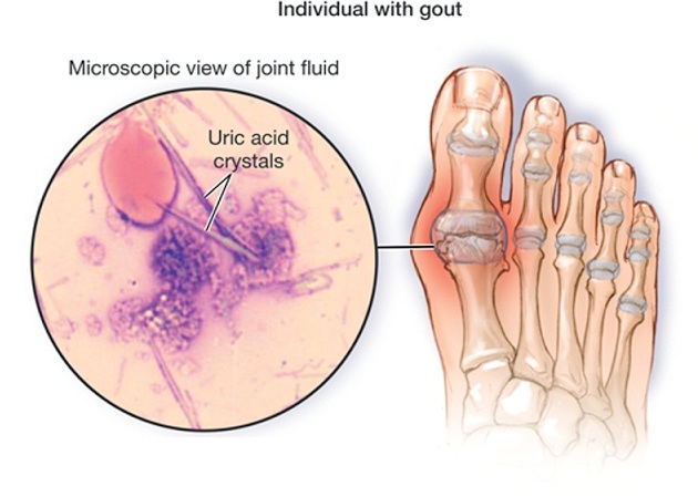 What can cause gout?