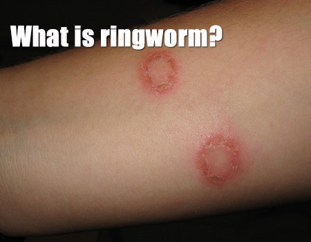 Ringworm of the Skin - eMedicineHealth