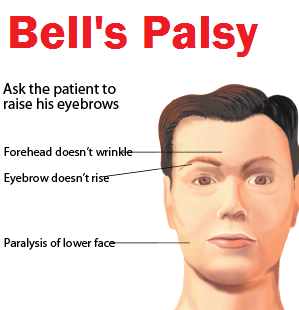 Facial Muscle Paralysis 71