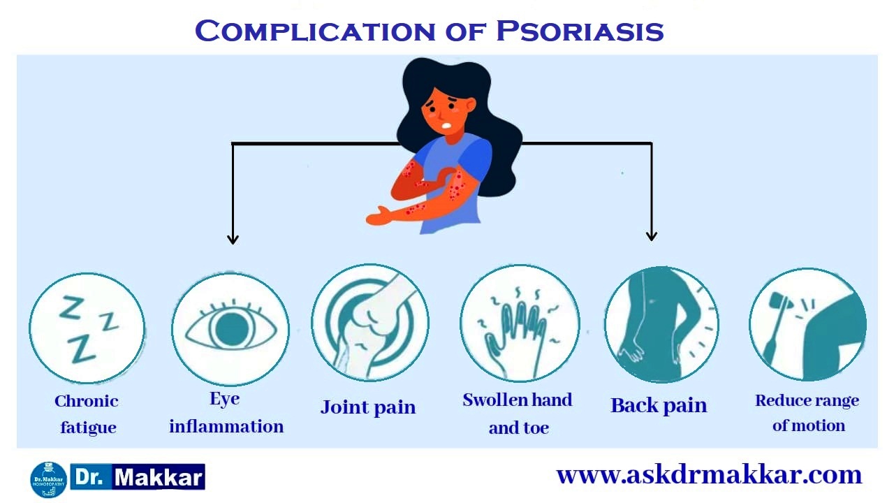 Complications of psoriasis  || सोरायसिस की जटिलताएं