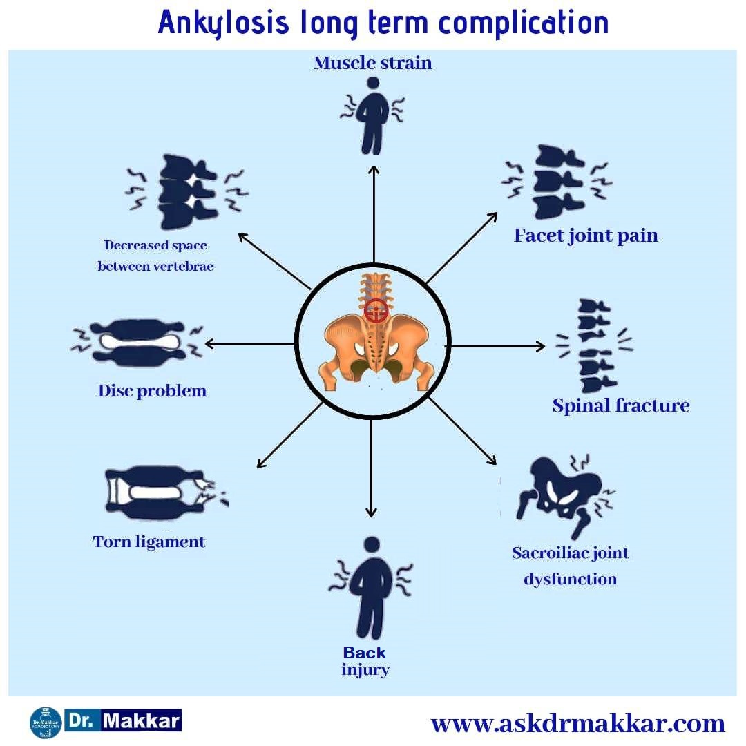 Ankylosis long term impact on body effect Pelvis,Sacroiliac joints & Spine in detail