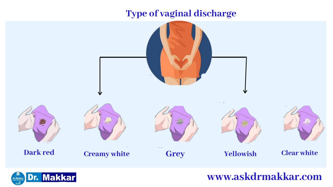 Based on colour of vaginal discharge the specific type of discharge meaning   योनि स्राव के रंग के आधार पर विशिष्ट प्रकार के निर्वहन अर्थ