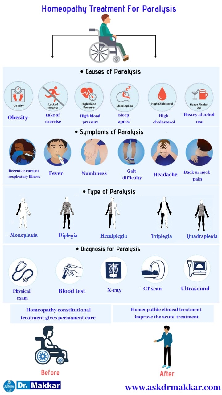 Best Homeopathic Treatment approach to Paralysis || लकवा मारना का होम्योपैथिक दवा से इलाज पक्षाघात होम्योपैथिक ट्रीटमेंट