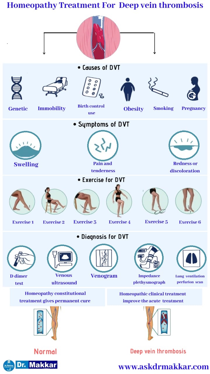 Best Homeopathic Treatment approach to  Deep Vein Thrombosis DVT  ||  डीप वेन थ्राम्बोसिस  का होम्योपैथिक दवा से इलाज डीवीटी  होम्योपैथिक ट्रीटमेंट