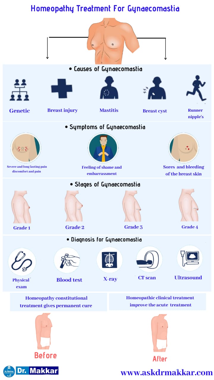 Best Homeopathic Treatment approach to  Gynecomastia Enlarged Male Breast Tissue || ज्ञ्नेकोमास्टिया बढ़े हुए पुरुष स्तन ऊतकका होम्योपैथिक दवा से इलाज होम्योपैथिक ट्रीटमेंट