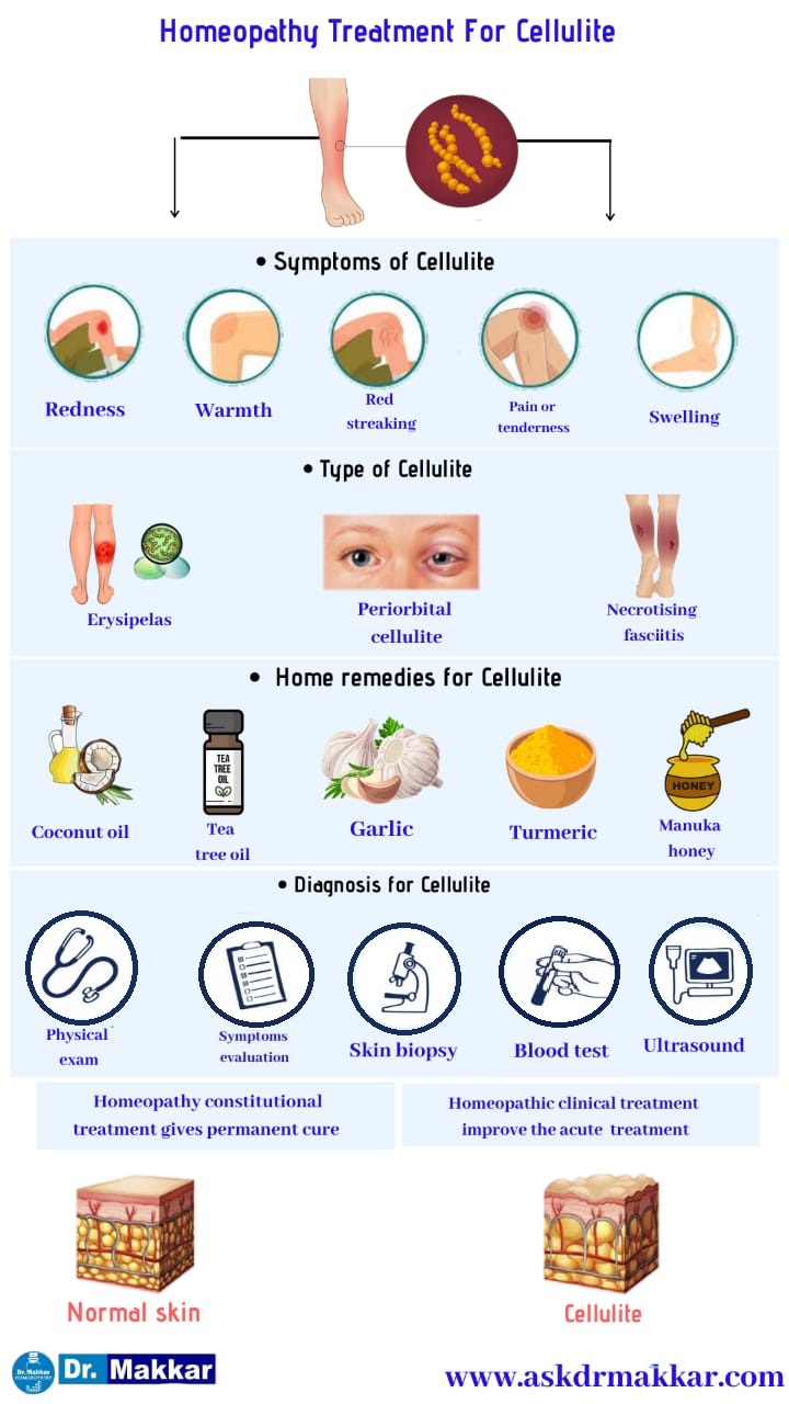 Best Homeopathic Treatment approach to Cellulitis Skin Infection with medicines || सेल्यूलाइटिस स्किन इंफेक्शन का श्रेष्ठ होम्योपैथिक दवाएं से इलाज सर्वश्रेष्ठ ट्रीटमेंट
