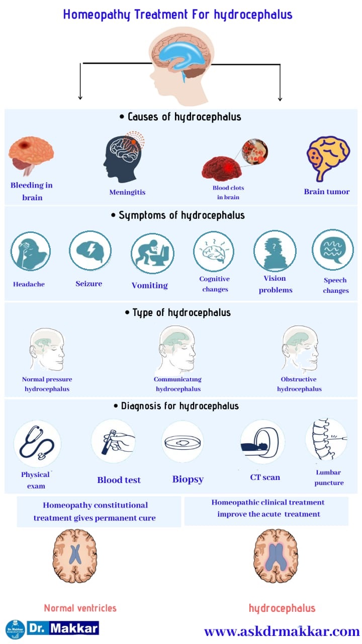 Best Homeopathic Treatment approach to Hydrocephalus || जलशीर्ष हाइड्रोसेफ़लस का होम्योपैथिक दवा से इलाज होम्योपैथिक ट्रीटमेंट