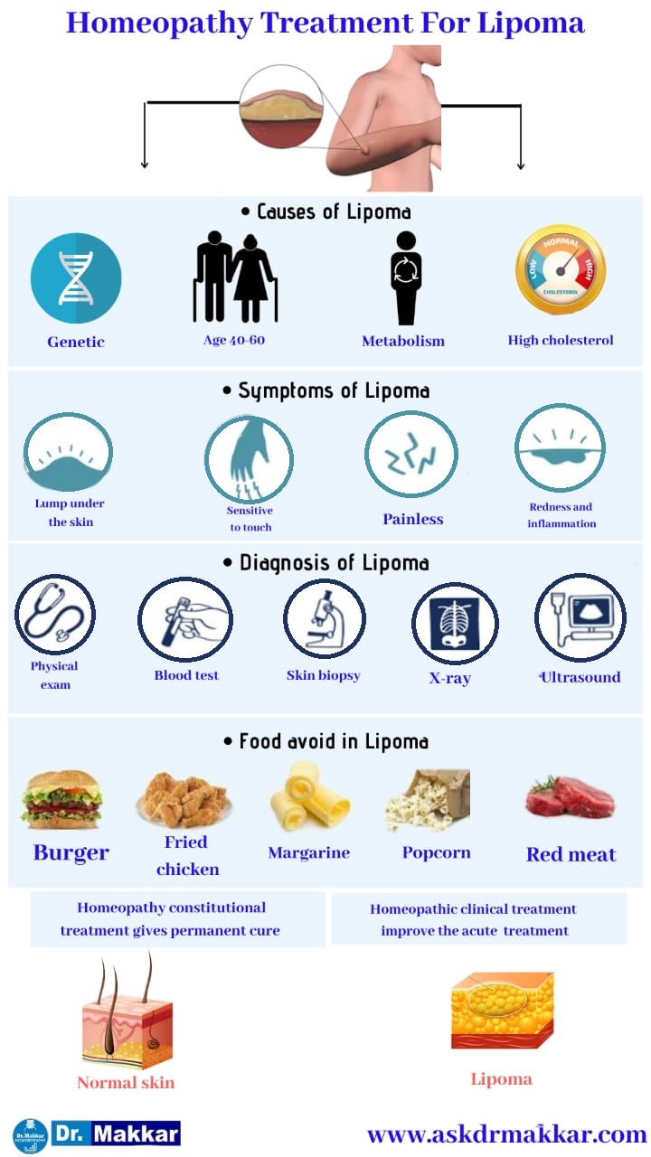 Best Homeopathic Treatment approach to Lipoma Benign Tumour under skin || चर्बी की गांठ लिपोमा का सर्वश्रेष्ठ होम्योपैथिक दवा  से उपचार के साथ से होम्योपैथिक ट्रीटमेंट सर्वश्रेष्ठ होम्योपैथिक चिकित्सा होम्योपैथिक दवा इलाज 