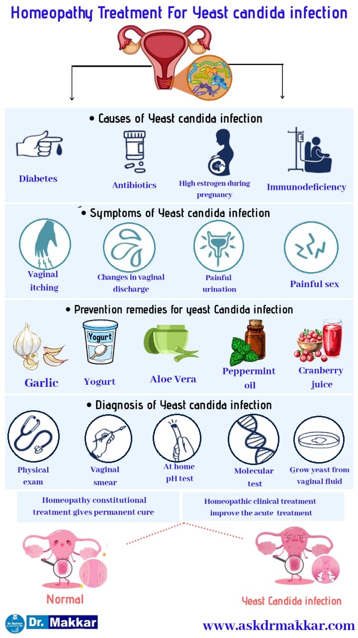 Best Homeopathic Treatment approach to Vaginal Yeast Candidiasis || यीस्ट वेजाइना योनि में खुजली जलन संक्रमण तरुण योनि शोथ का होम्योपैथिक इलाज 