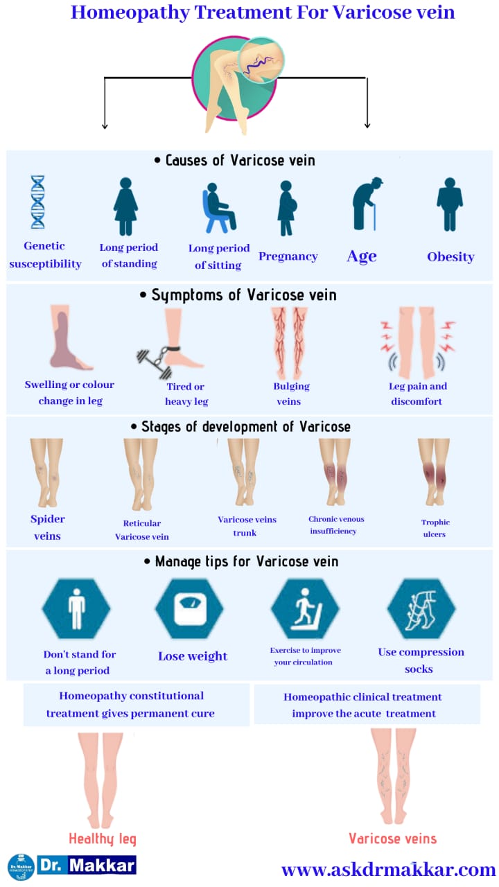 Best Homeopathic Treatment approach toVaricose Veins with Medicines   वैरिकाज़ नसों का होम्योपैथिक इलाज  के साथ बेस्ट होम्योपैथिक दवा  