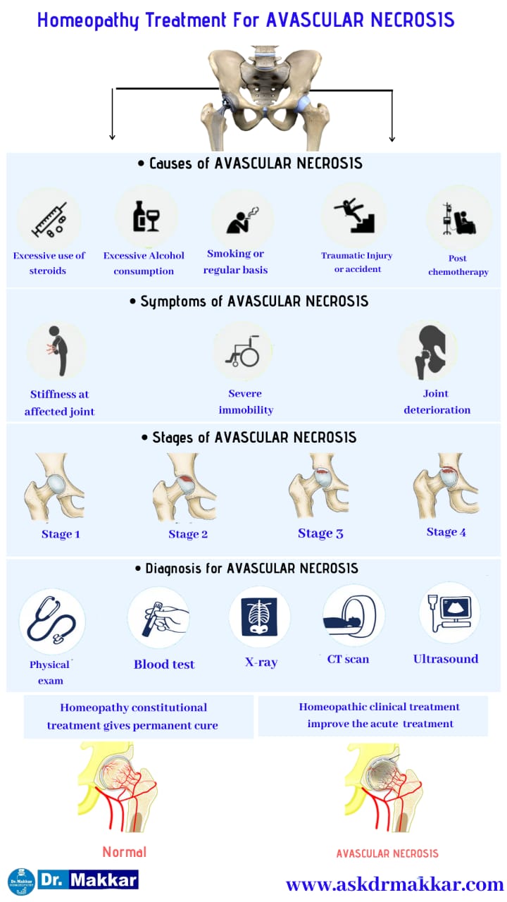 Best Homeopathic Treatment for Avascular Ischemic Necrosis AVN Osteonecrosis femur || एवस्कुलर इस्केमिक नेक्रोसिस एवीएन ओस्टियोनेक्रोसिस फीमर हड्डी की सर्वश्रेष्ठ होम्योपैथिक ट्रीटमेंट इलाज दवा से होम्योपैथिकइलाज 