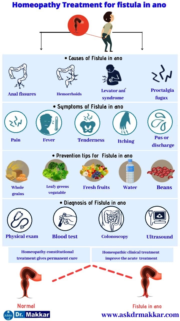 Best Homeopathic Treatment for Fistula fissure in ano || भगन्दर एनल फिस्टुला की होम्योपैथिक ट्रीटमे