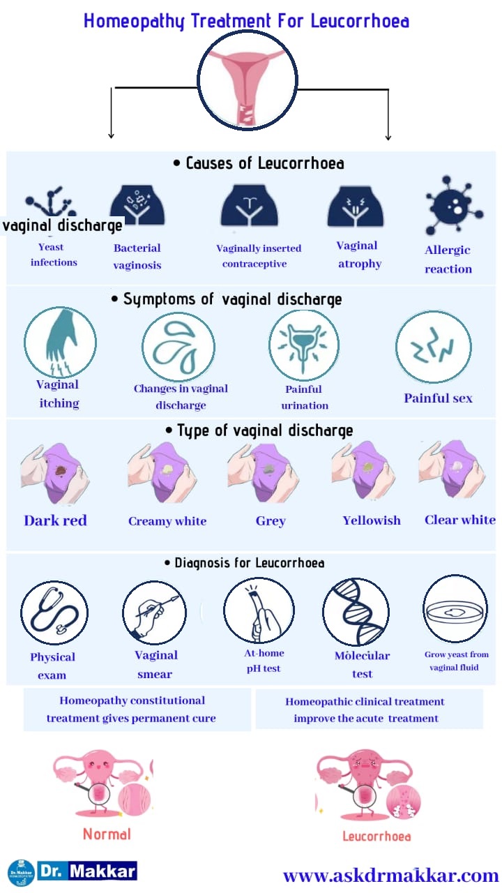 Best Homeopathic Treatment for Leucorrhoea which also called as white discharge || ल्यूकोरिया के लिए सर्वश्रेष्ठ होम्योपैथिक उपचार जिसे श्वेत प्रदर भी कहा जाता है