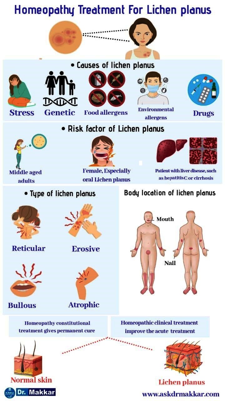 Best Homeopathic Treatment for Lichen Planus in india punjabBest Homeopathic Approach for  Lichen Planus through Homeopathic treatment by best medicine || सर्वश्रेष्ठ चिकित्सा द्वारा होम्योपैथिक उपचार के माध्यम से लिचेन प्लेनस के लिए सर्वश्रेष्ठ होम्योपैथिक दृष्टिकोण