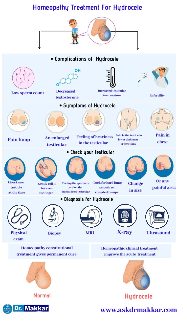 Best Homeopathic Treatment for hydrocele with medicine दवा के साथ हाइड्रोसेले के लिए सर्वश्रेष्ठ होम्योपैथिक उपचार