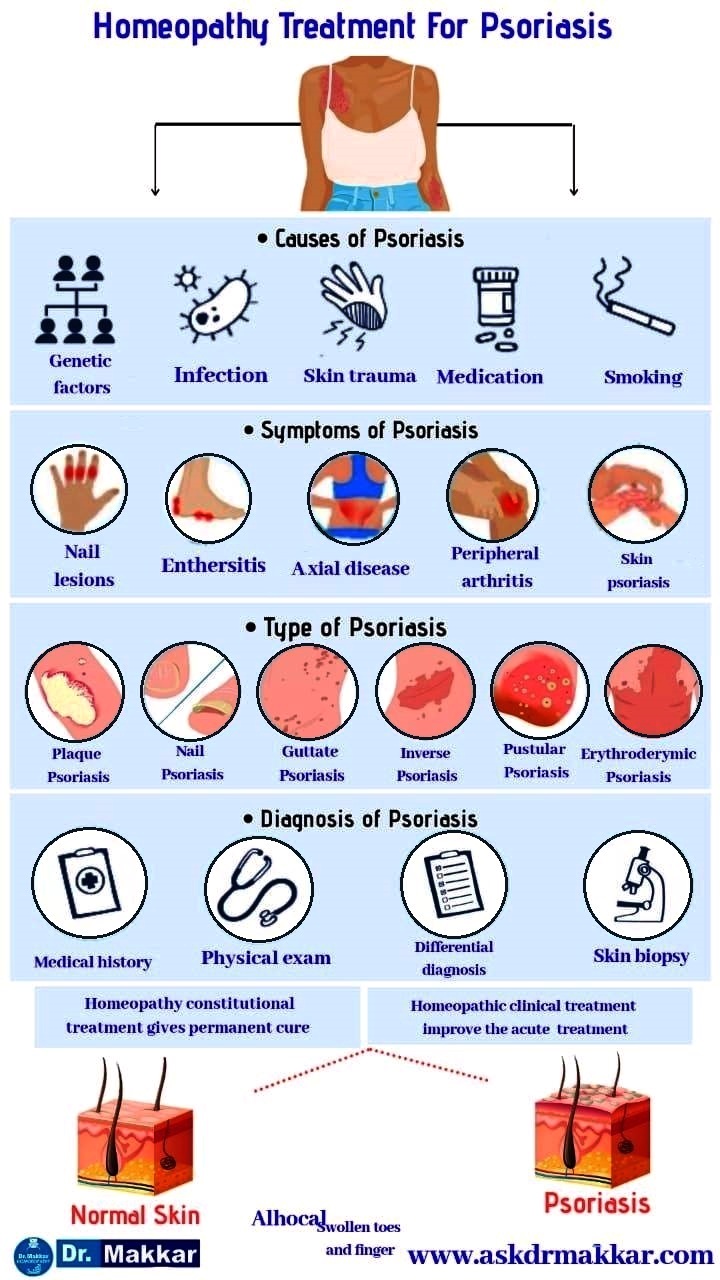 Best Homeopathic Medicines for Psoriasis: ||  सोरायसिस बीमारी कैसे ठीक होती है? होम्योपैथिक ट्रीटमेंट दवा इलाज