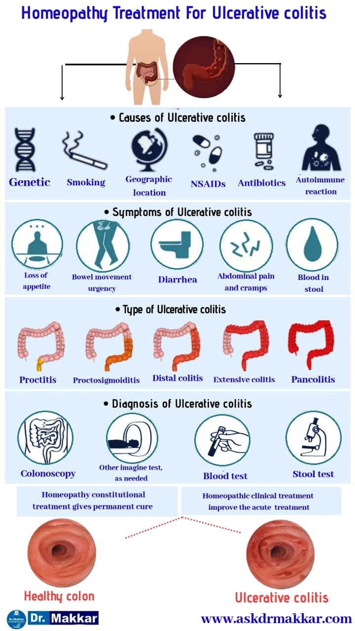 Best Homeopathic treatment is best for  Ulcerative Colitis    आंतों में सूजन अल् सरेटिव कोलाइटिस का इलाज होम्योपैथिक उपचार