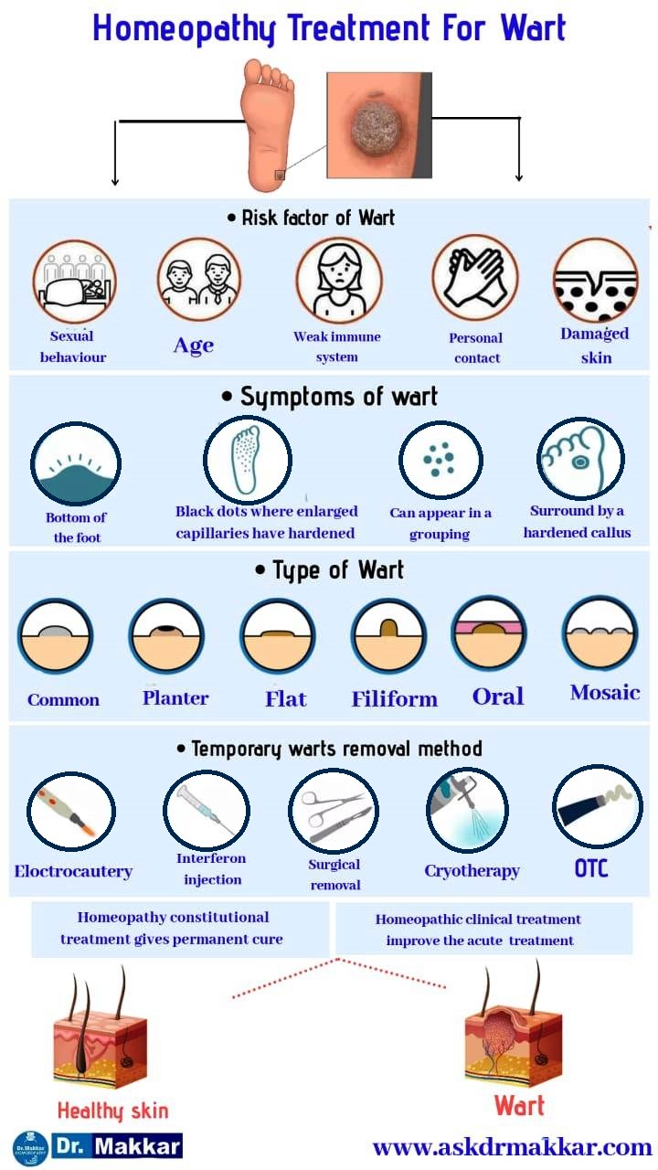 Best Homoeopathic Treatment for Warts By Dr Makkar || कॉमन वार्ट्स मस्से का होम्योपैथिक इलाज