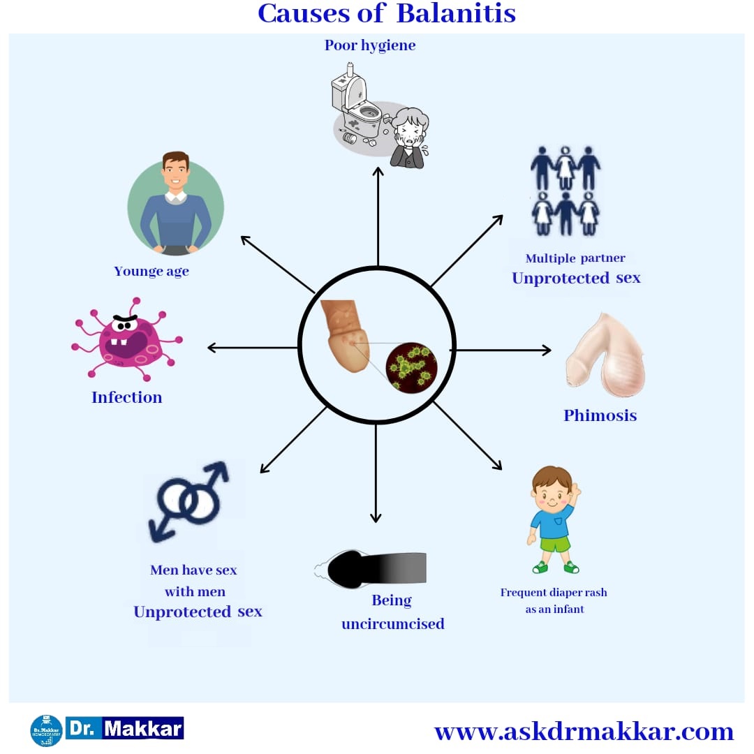 Causes of Balanitis  बैलेनाइटिस के कारण
