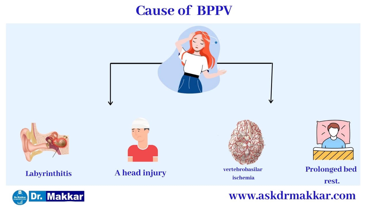 Cause of Benign Paroxysmal Positional Vertigo BPPV ||  बिनाइन पैरॉक्सिसमल पोजिशनल वर्टिगो सिर घूमना के कारण