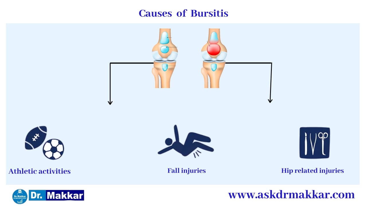 Cause of Bursitis ||  बर्साइटिस  के कारण