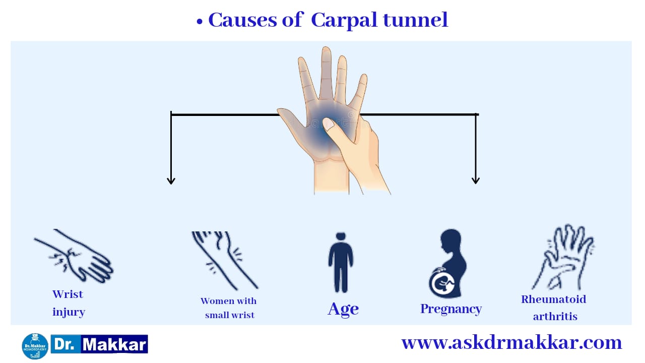 Cause of Carpal tunnel syndrome ||  कार्पल टनल सिंड्रोम के कारण