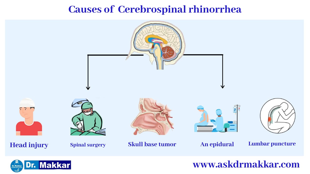 Cause of Cerebrospinal Fluid (CSF) Leak Rhinorrhea ||  सेरिब्रल स्पाइनल फ्लूइड लीक रिसाव राइनोरिया के कारण