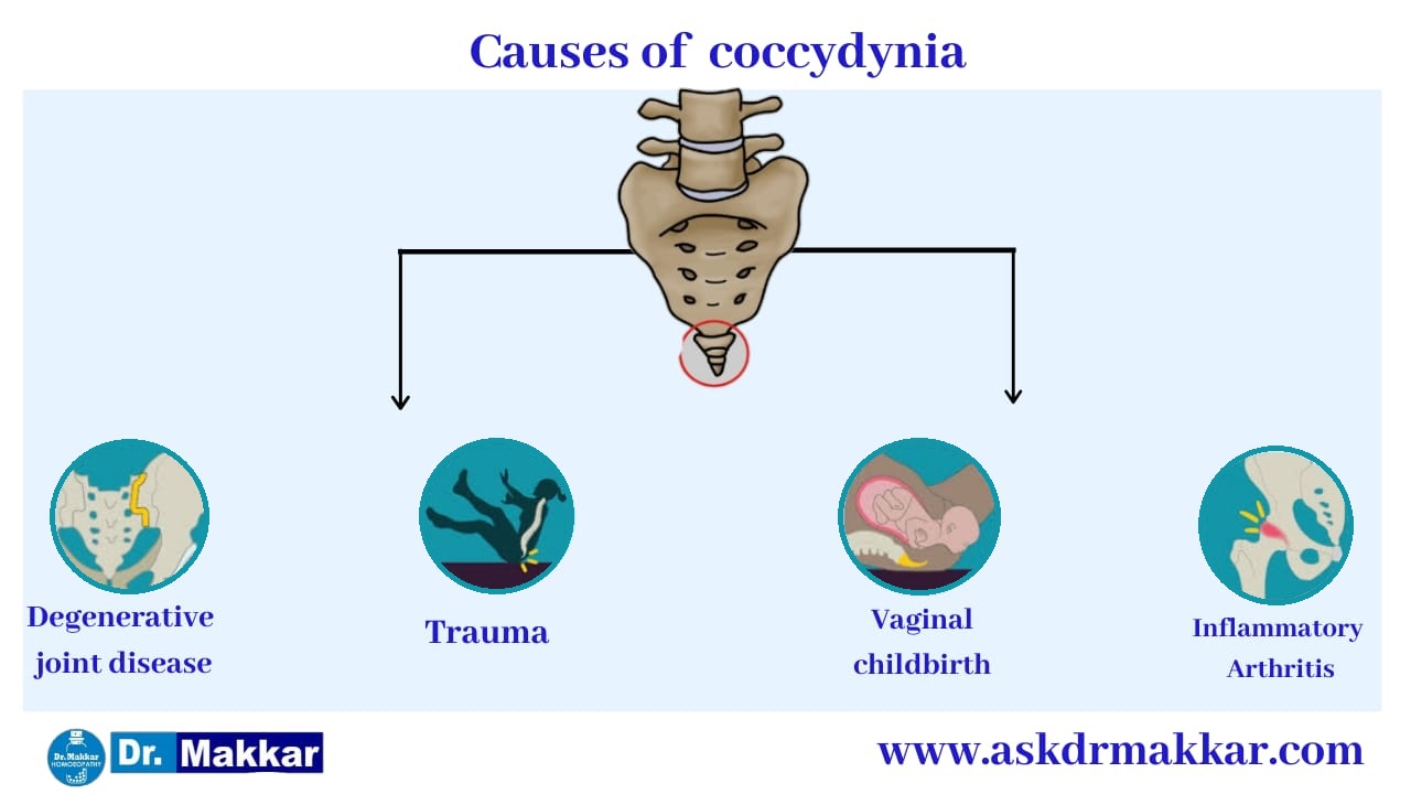 Cause of Coccydynia due to Tailbone pain  ||  कोक्सीडीनिया टेलबोन दर्द के कारण
