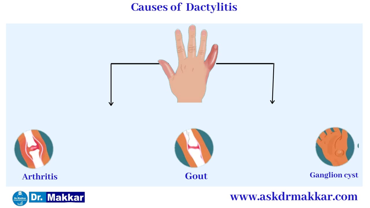 Cause of Dactylitis Swelling in Digits Toes Fingers  ||  डक्टाइलिटिस के कारण हाथ पैरों की सूजन 