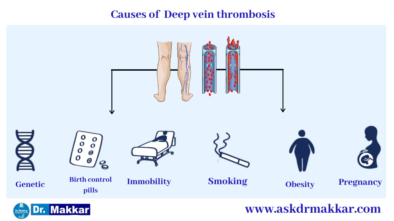 Cause of Deep Vein Thrombosis DVT  ||  डीप वेन थ्राम्बोसिस डीवीटी  के कारण