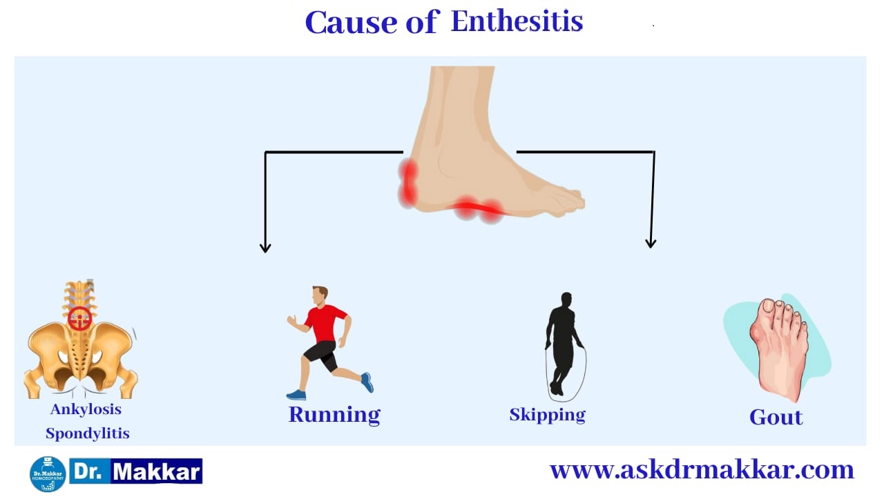 Cause of Enthesitis SpondyloArthritis || एंथेसिसिटिस स्पोंडिलोआर्थराइटिस के कारण