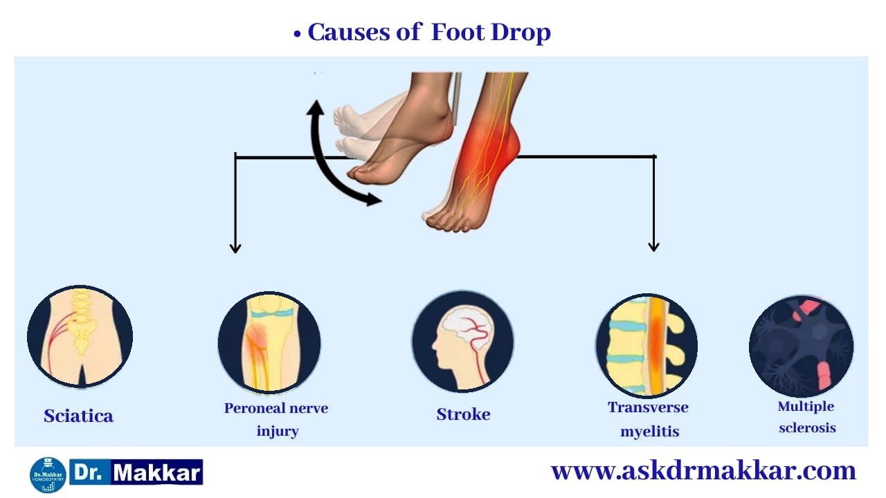 Cause of Foot Drop Peroneal Nerve ||  फुट ड्राँप अनुजंघास्थिक तंत्रिका चोट के कारण