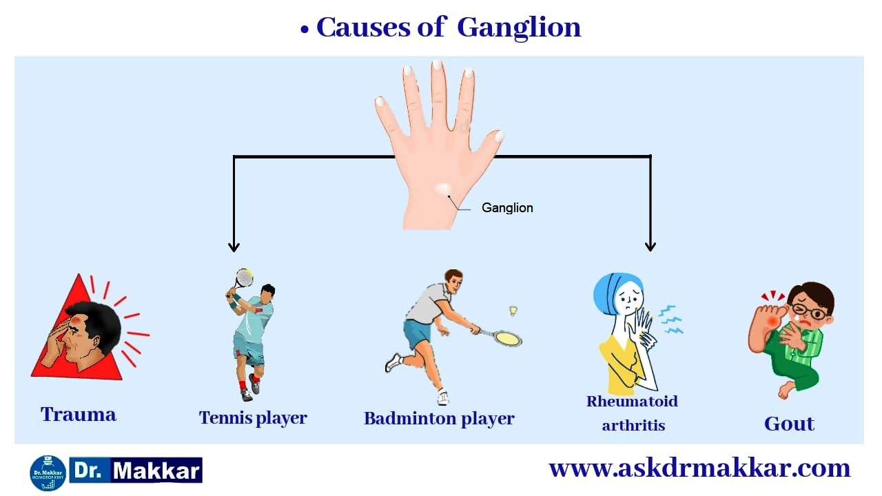 Cause of Ganglion ||  नाड़ीग्रन्थि गांठ गांठ के कारण