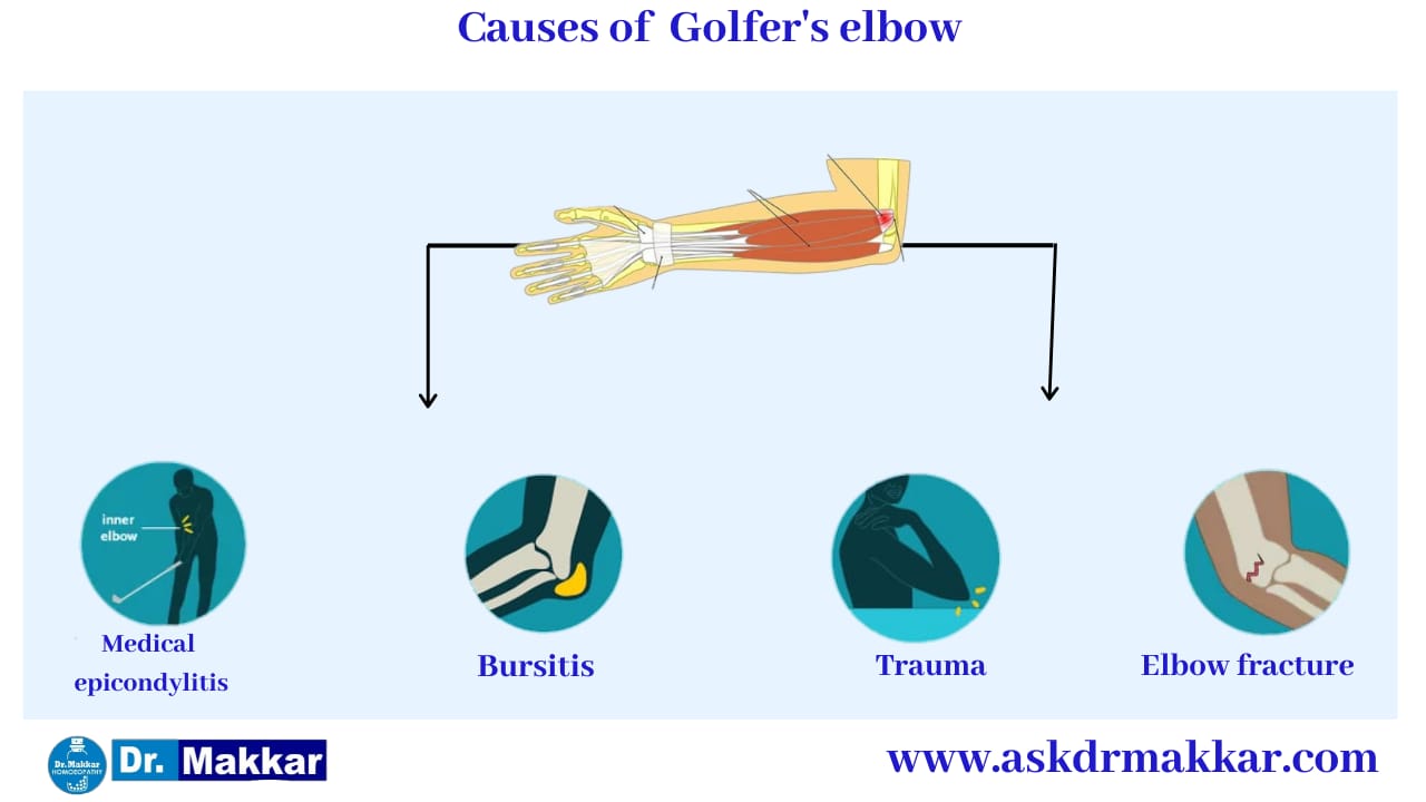 Cause of Golfers Elbow || गोल्फर एल्बो के  कारण