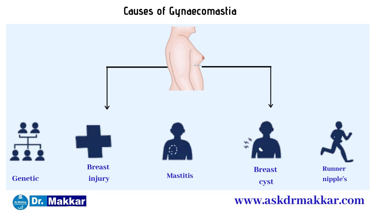 Cause of Gynecomastia Enlarged Male Breast Tissue || ज्ञ्नेकोमास्टिया बढ़े हुए पुरुष स्तन ऊतक के कारण
