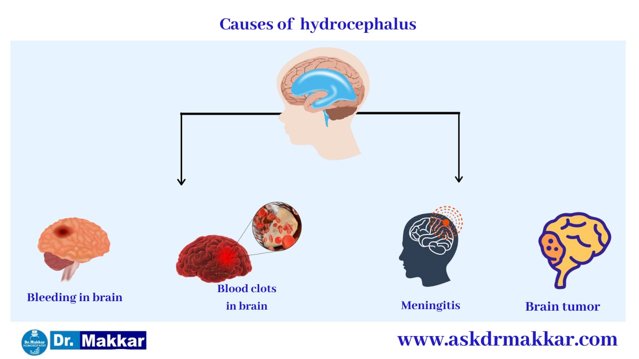 Cause of Hydrocephalus ||  जलशीर्ष हाइड्रोसेफ़लस के कारण
