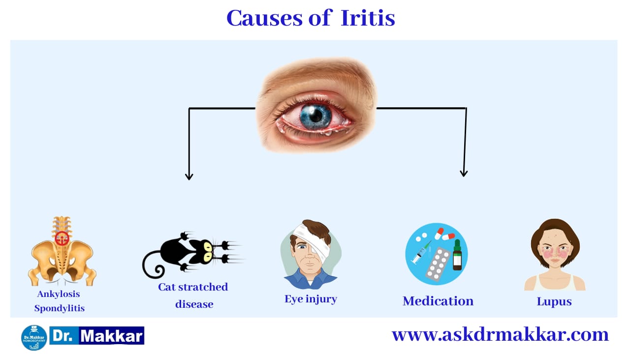 Cause of Iritis Anterior Uveitis || "एंटीरियर यूवाइटिस" या इरिडोसाइक्लाइटिस के कारण