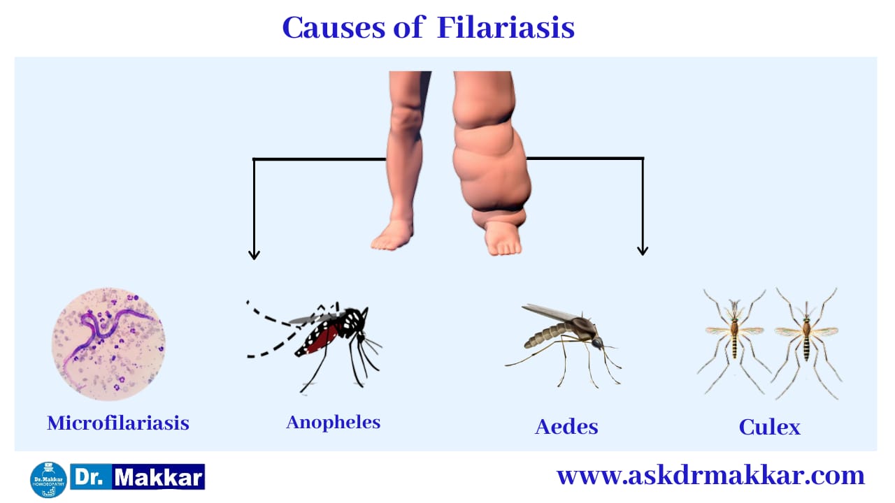 Cause of Lymphatic Filariasis elephantiasis   लसीका फाइलेरिया  हाथी पांव  के कारण