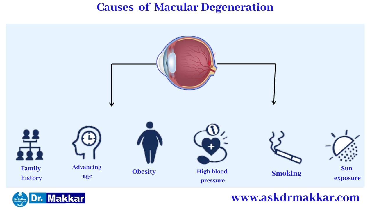 Cause of Macular degeneration ARMD || मैक्युलर डीजेनेरेशन के कारण